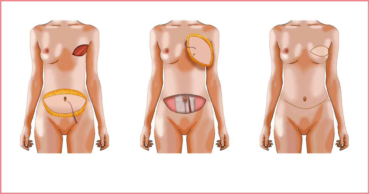 同院で行われる深下腹壁動脈穿通枝皮弁。腹部の脂肪を胸部に移植し、整った形や、温かみ、柔らさを目指す