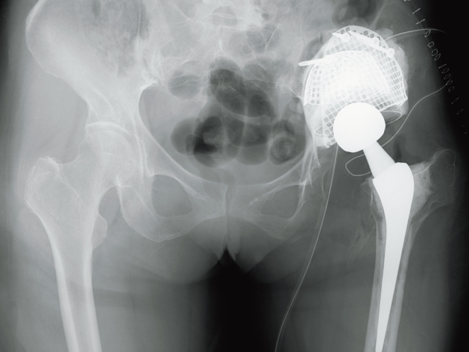 中心性脱臼の患者に対し、メッシュとステンレスを用いた人工股関節再置換術を実施