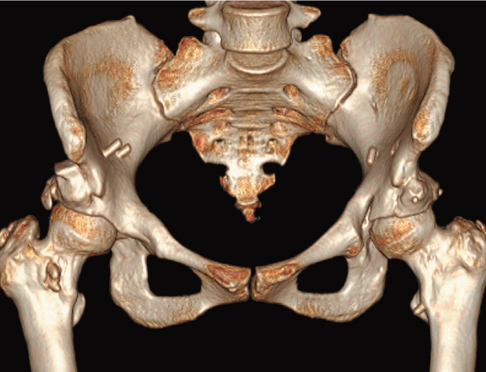 臼蓋回転骨切り術を行った後の3D-CT画像