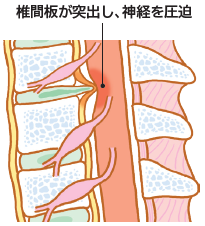 頸椎椎間板ヘルニア