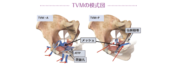 TVMの模式図