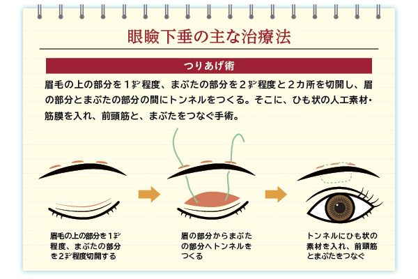 眼瞼下垂の主な治療法