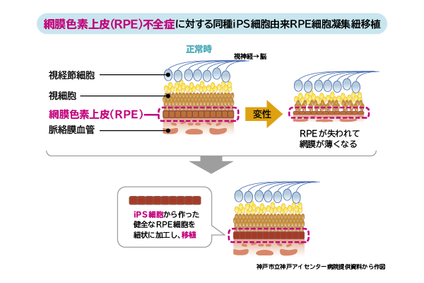 網膜色素上皮（RPE）不全症に対する同種iPS細胞由来RPE細胞凝集紐移植