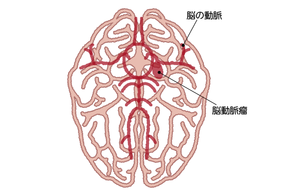 脳動脈瘤・脳の動脈