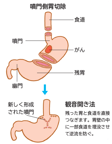 胃がんの手術方法