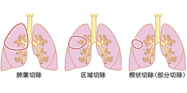 肺がんの手術方式